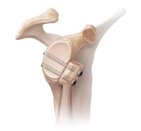 Latarjet — the coracoid, with its attached tendon, is transferred and fixed to the front of the glenoid