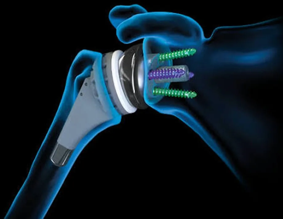 Reverse total shoulder implant — the ball sits on the socket side and the socket on the arm side, so the deltoid can power the arm