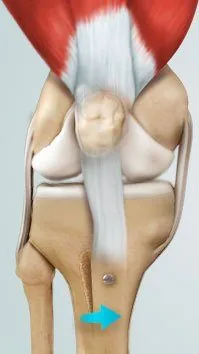 Tibial tubercle osteotomy — the bony attachment of the patellar tendon is moved to realign how the kneecap tracks