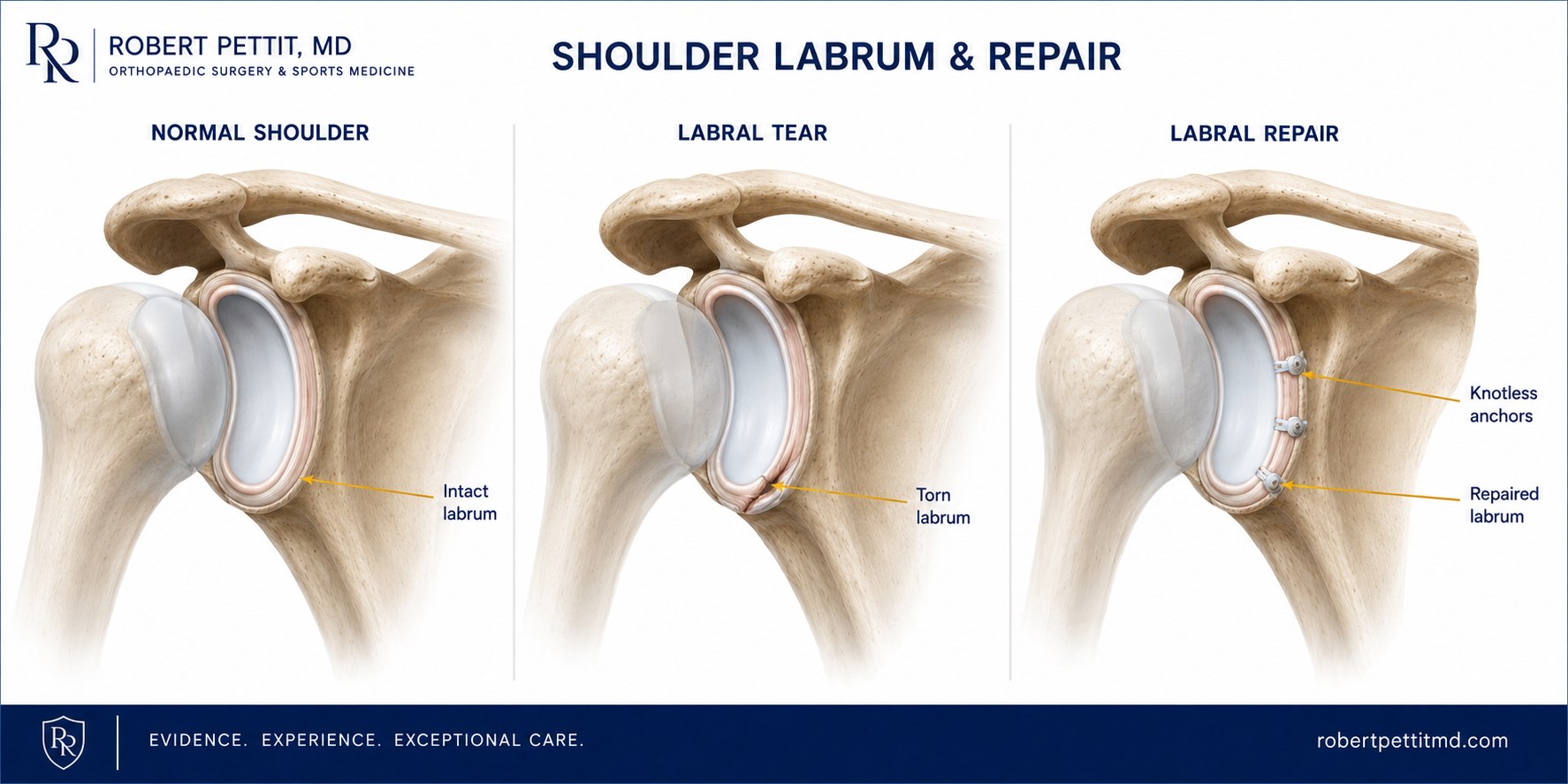 Shoulder labrum tear and arthroscopic labral repair infographic by Dr. Robert Pettit