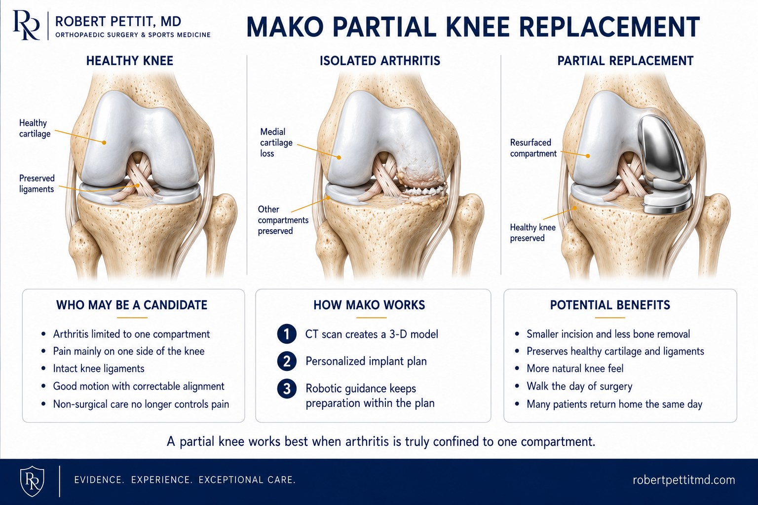 Mako partial (unicompartmental) knee replacement infographic by Dr. Robert Pettit