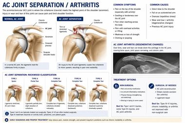 Shoulder Separation (AC Joint) infographic — Robert Pettit, MD