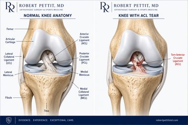 ACL Tear infographic — Robert Pettit, MD