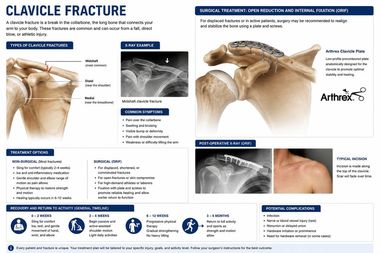 Clavicle (Collarbone) Fractures infographic — Robert Pettit, MD