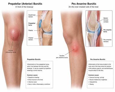 Knee Bursitis infographic — Robert Pettit, MD