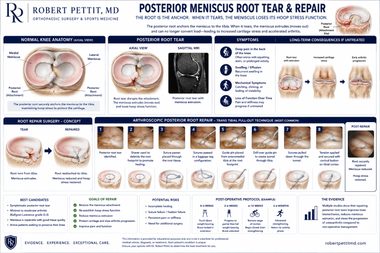 Meniscus Root Tears infographic — Robert Pettit, MD