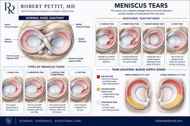 Meniscus Tears infographic — Robert Pettit, MD