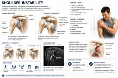Shoulder Instability infographic — Robert Pettit, MD