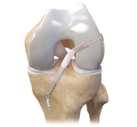 ACL reconstruction: a new graft passes through tunnels in the tibia and femur and is fixed with a button and screw