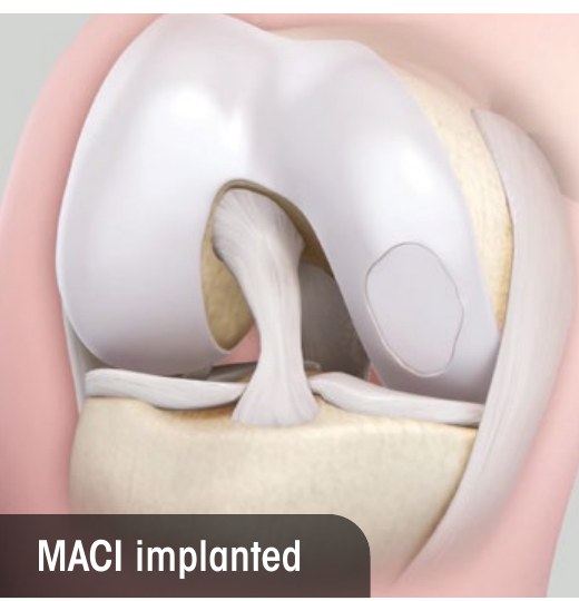 Knee after MACI: the cultured-cell membrane implanted into the cartilage defect