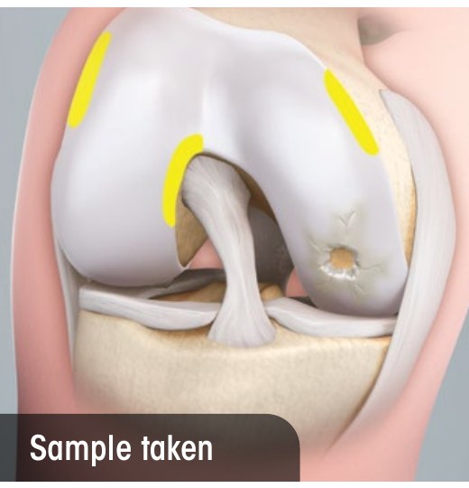 Knee with a cartilage defect and the small biopsy sites where cells are taken during arthroscopy