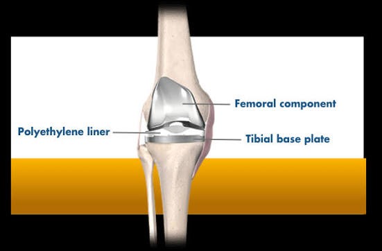 Total knee replacement components: femoral component, polyethylene liner, and tibial base plate