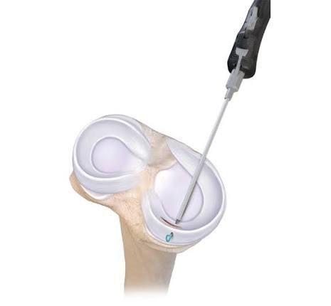 All-inside meniscus repair: a suture device passed through the arthroscope anchors the torn meniscus back to its rim