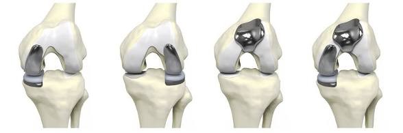 Partial knee replacement options: medial, lateral, patellofemoral, and combined compartments resurfaced with the rest of the knee left intact