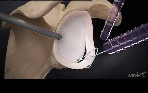 Arthroscopic labral repair: knotless soft suture anchors reattach the torn labrum to the rim of the socket